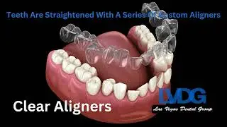 Clear Aligners Invisalign Las Vegas Dental Group | Straighter Teeth With Clear Aligners LVDG