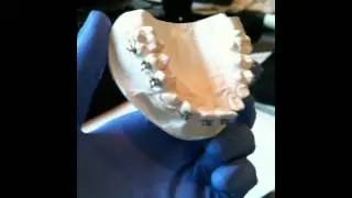 Indirect Bonding #1
