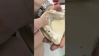 Part 1 of Replacing Missing Teeth!