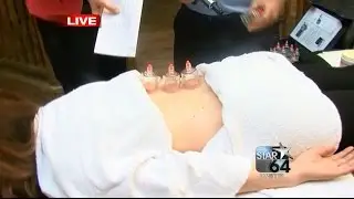 Physical therapist demonstrates cupping treatment