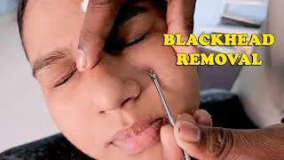 Blackhead & Pimple Removal with Relaxing Face Massage | ASMR 😴| MICHAEL BARBER