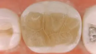 Class II lower 6 composite filling restoration