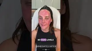 GET OUT OF HERE ACNE SCARS 🚫 | Dr. Jason Emer #shortsvideo #doctor #reels #shorts #losangeles