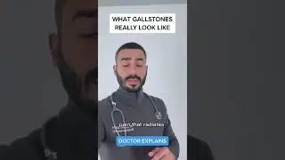 What gallstones look like and how to identify gallstone disease #gallstones #liver #gallbladder