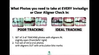 Invisalign and Clear Aligner Check In Photos- Tracking, Refinement