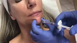 Comblement du menton par injections d'acide hyaluronique - Dr Body à Tours