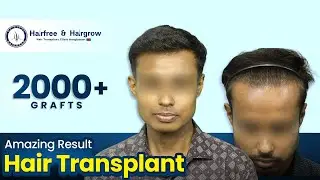 Before & After: 2000 Grafts Hair Transplant | Grade 2 | 6-Month Results | Bangladesh