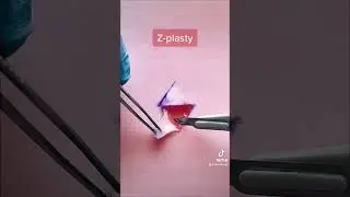 Z-plasty: incision