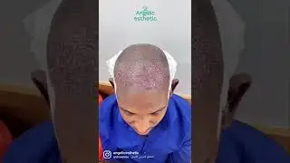 Smooth hair transplant with Angelic esthetic...  #hairtransplant #clinic #istanbul #turkey