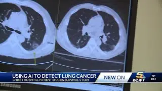Christ Hospital patient shares survival story after AI detects lung cancer