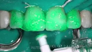 White spot treatment with DMG ICON