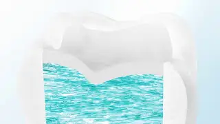 Stop Tooth Fracture, Prevent Crack Propagation in Large Posterior Restorations