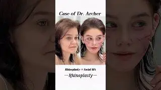 #鼻整形 #Rhinoplasty #鼻修复 #noserepair #nose