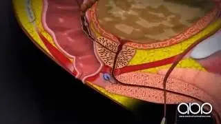 Prostate Cancer (Labelled) - 3D Medical Animation || ABP &copy;