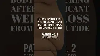 Before & After 100 lb Ozempic Weight Loss #massiveweightloss #bodycontouring #tummytuck #renuvion