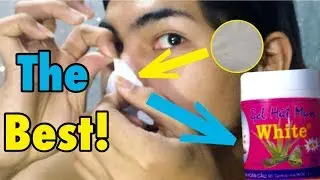 Effective Blackheads and Whiteheads Remover | Jd Gonzales
