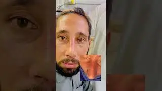 Patient Feedback Afterr Rhinoplasty #rhinoplasty #skincare #viralshort #reels #beauty #pakistan