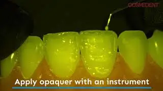 Enhancing the Halo Effect on Composite Restorations with Creative Color Opaquers