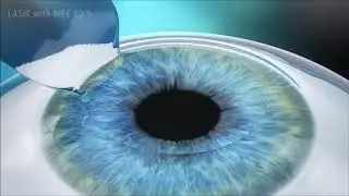 LASIk Eye Surgery with Microkeratome (Zeiss)