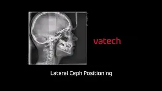 Cephalometric Lateral: Capture Protocol