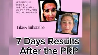 PRP Facial Treatment: What to Expect with Vampire Facial - platelet rich plasma