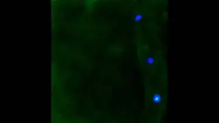 Bone marrow mesenchymal stroma cell as a harbor anchoring acute B lymphoblastic leukemia cells mmc4