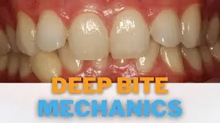 Course preview - Deep bite mechanics