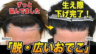 【指導医が解説】生まれつき広いおでこは治せる。1250株の植毛で生え際を下げた結果【術後1年】【湘南AGA仙台院 藤井医師】｜No.178