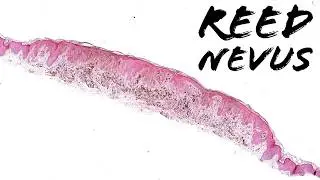 Pigmented spindle cell nevus of Reed (Reed nevus - subtype of Spitz nevus?) pathology histology
