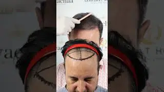 Естественная густота, которая выглядит нереально! Лучшие результаты пересадки волос в Агре, Индия...