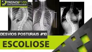 Escoliose - Como identificar - Desvios Posturais #10