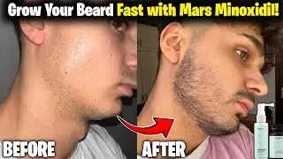 Mars Minoxidil Review with Derma Roller | Beard Growth Journey | minoxidil beard growth |