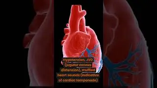 Triads Part 1: Beck's Triad, Cardiac Tamponade #medicine #shorts