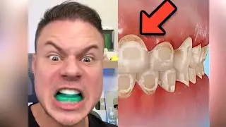 Can You Whiten Your Teeth With Braces? Experiment Update!