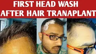 First head wash after hair transplant | Hair heal talks.