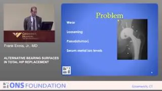 Alternative Bearing Surfaces in Total Hip Replacement