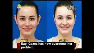 Incisionless Otoplasty - Estetik International