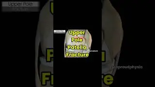 Patella Fracture | Upper pole fracture | Anatomy Video#fracture #patella #kneejoint #shortsfeed #yt