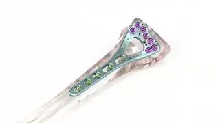 Variable Angle LCP Two Column Volar Distal Radius Plate