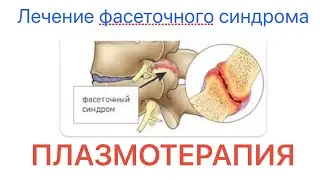 Лечим фасеточный синдром. Инъекции Плазмы крови прямо в суставы спины 