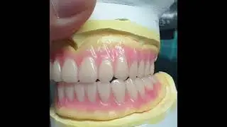 #dentures #teeth #smile #teethcleaning #easy_dentistry #shorts #dentist #youtubeshorts #instagram 🦷🦷