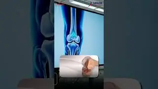 Regain Mobility, Relieve Pain &ndash; With Partial Knee Replacement!