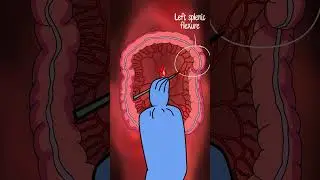 Colon Cancer Resection Explained | USMLE Step 1 & Step 2 High-Yield Anatomy Mnemonics