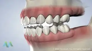 Full-Arch Restoration at Greater Michigan Oral Surgeons & Dental Implant Center
