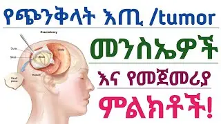 የጭንቅላት እጢ ምንነት፣ ምልክቶችና አጋላጭ ሁኔታዎች| Brain tumor causes and  symptoms