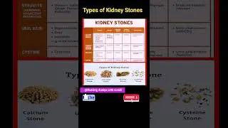 Types of Kidney Stones #kidneydisease#medical #nursing#shorts