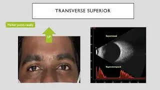 Ten tips to master ultrasound B‑scanof the posterior segment of the eye