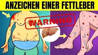 Eindeutige Anzeichen einer Fettleber