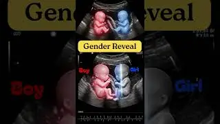 Amazing Gender Reveal in Pregnancy | Twins Ultrasound