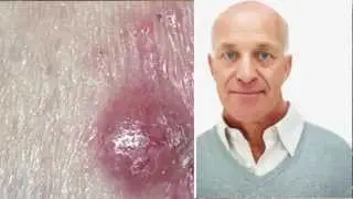 Skin Cancer - Risk Factors